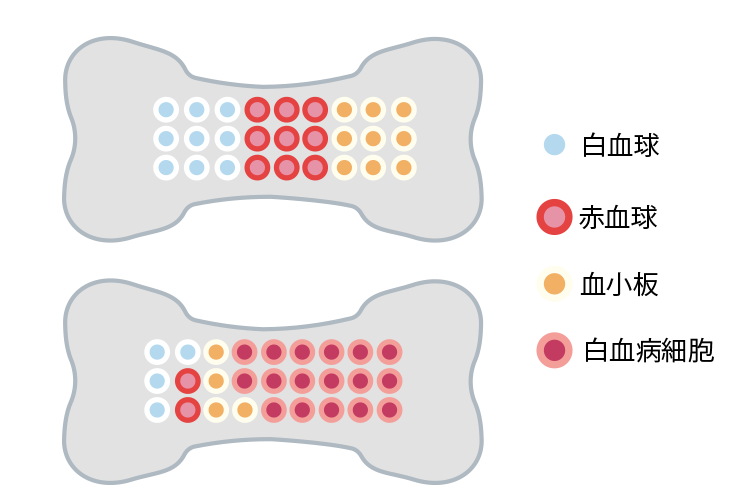 白血病の骨髄の図